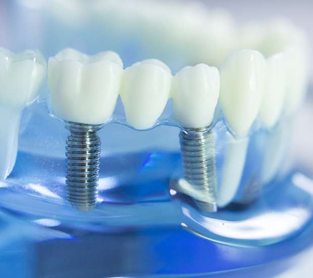 Owensboro Dental Implants